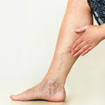 Where Can I Buy Compression Stockings for Varicose Veins?